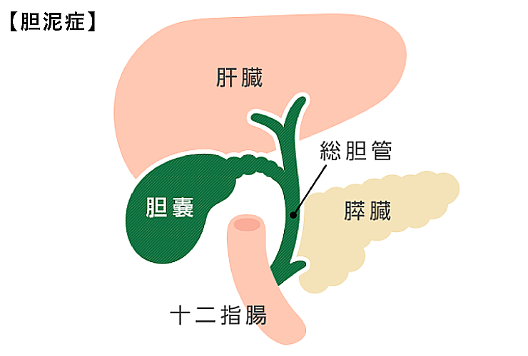 胆泥症(図)
