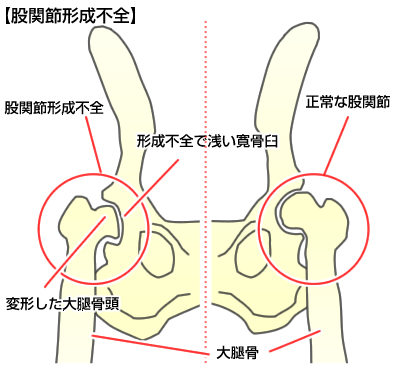 性 股関節 形成 不全 発育