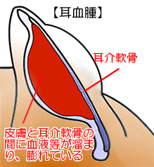 耳血腫