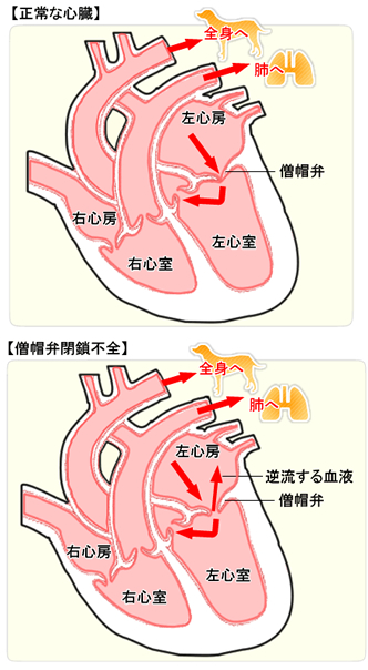 弁 僧 不全 症 閉鎖 帽