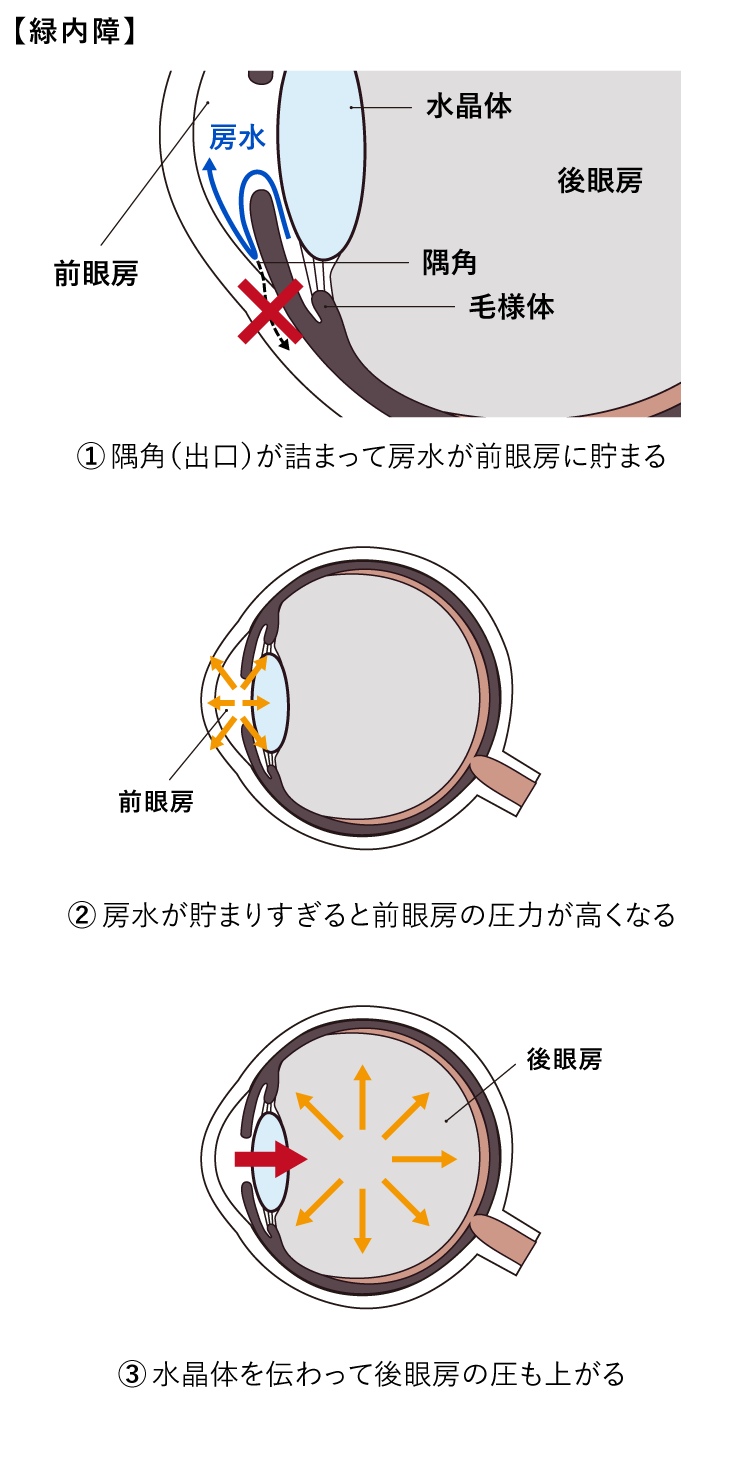 隅角が詰まって房水が前眼房に貯まる