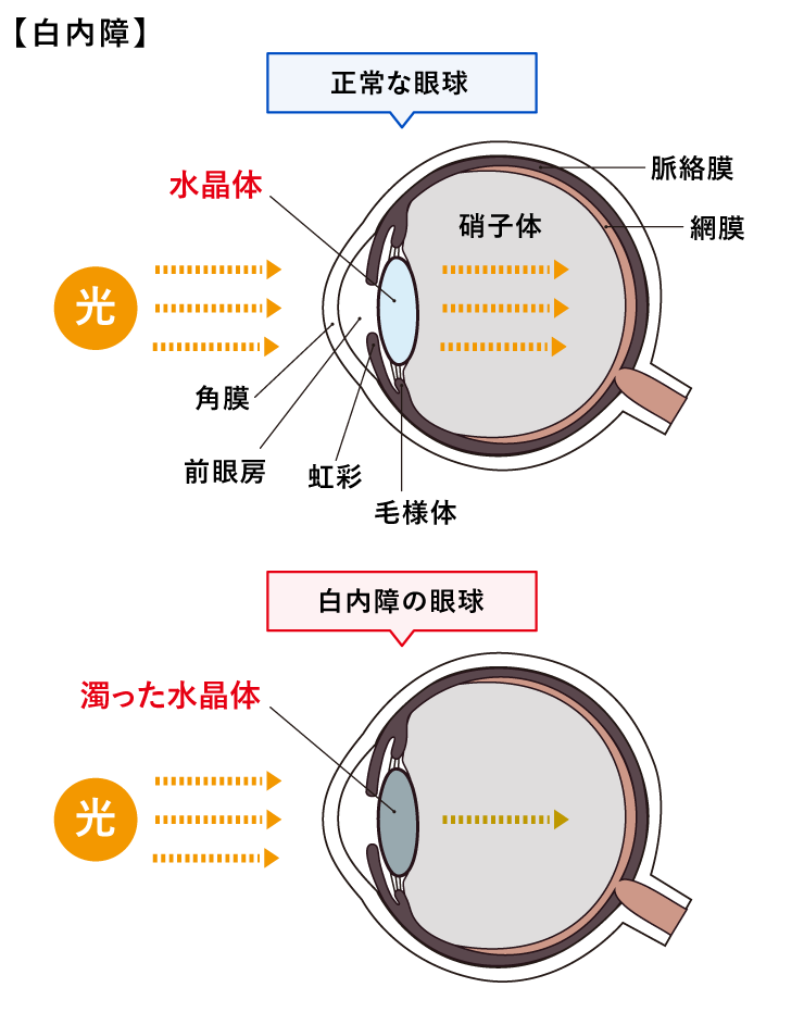 白内障