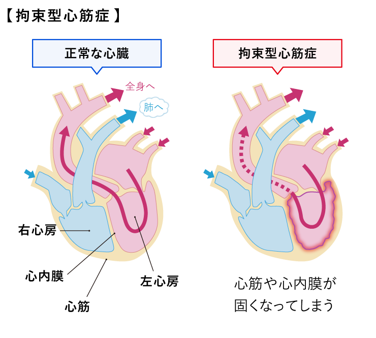 拘束型心筋症（図）