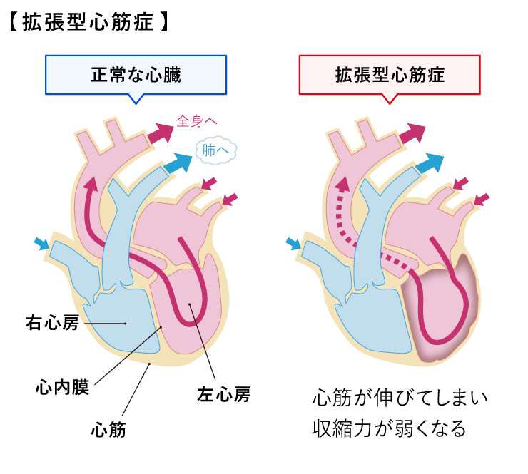 拡張型心筋症（図）