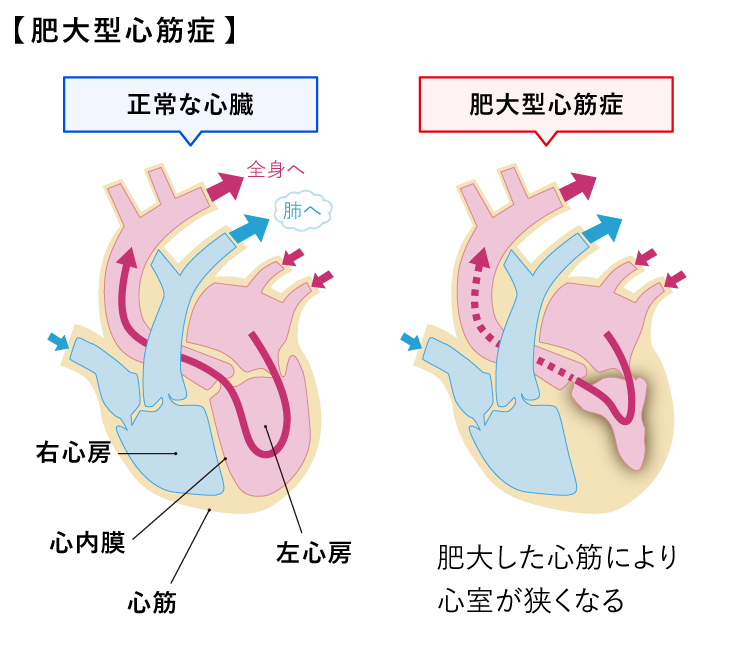 肥大型心筋症（図）