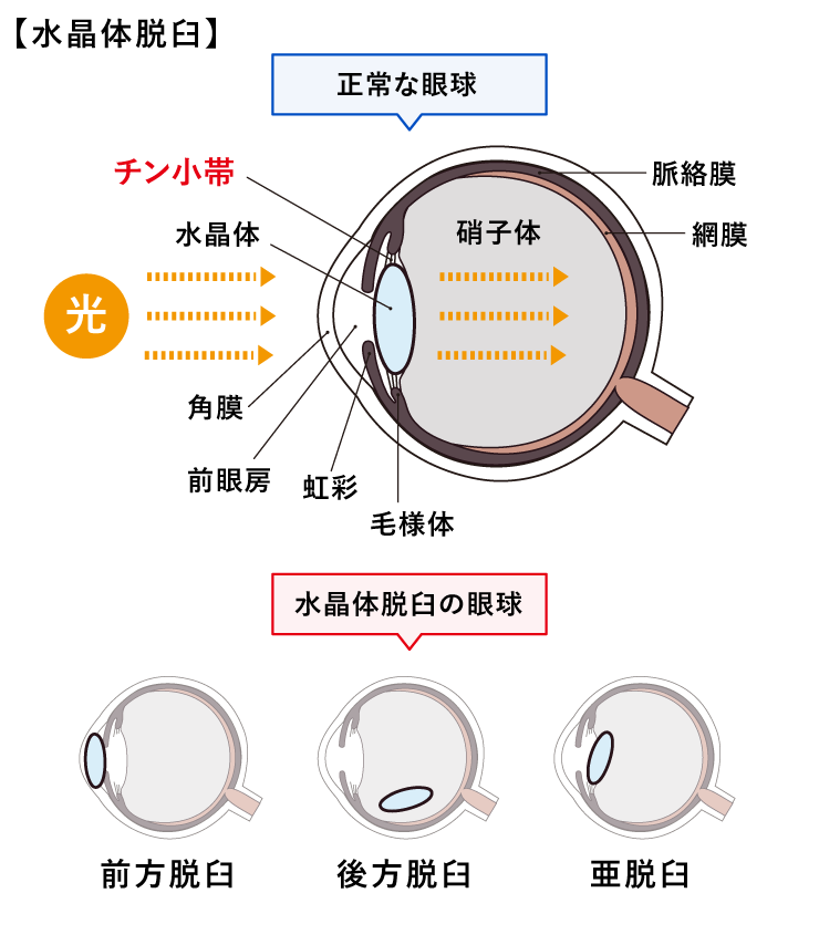 水晶体脱臼