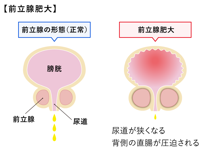 前立腺肥大<犬>図
