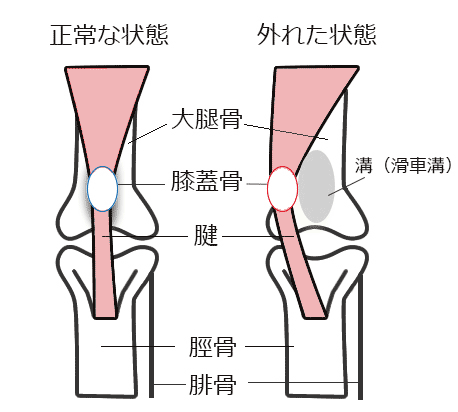 びっこを ひく 医療 用語